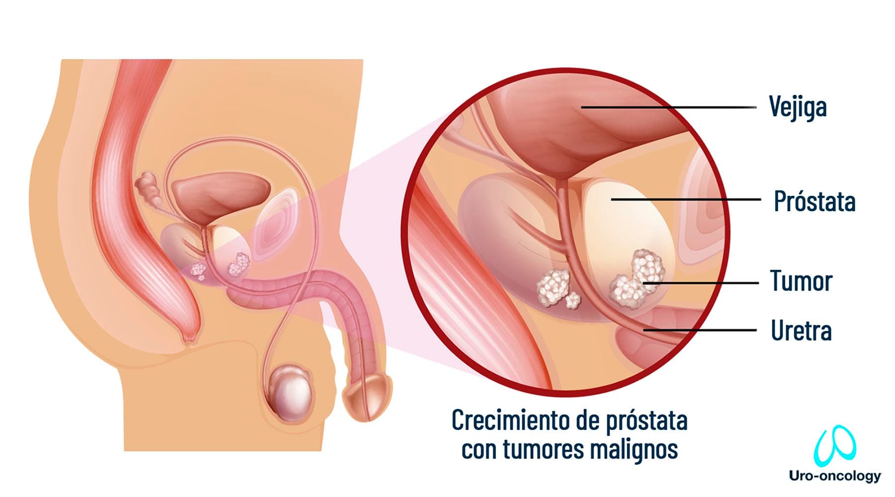 Detección oportuna del cáncer de próstata